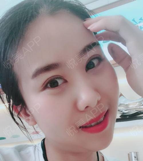 眼睛一點(diǎn)點(diǎn)恢復(fù)，越來(lái)越好看 眼部多項(xiàng)手術(shù)的蛻變之旅